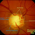 Bayoneting Sign In Glaucoma - Blood vessels can also be affected in glaucoma.