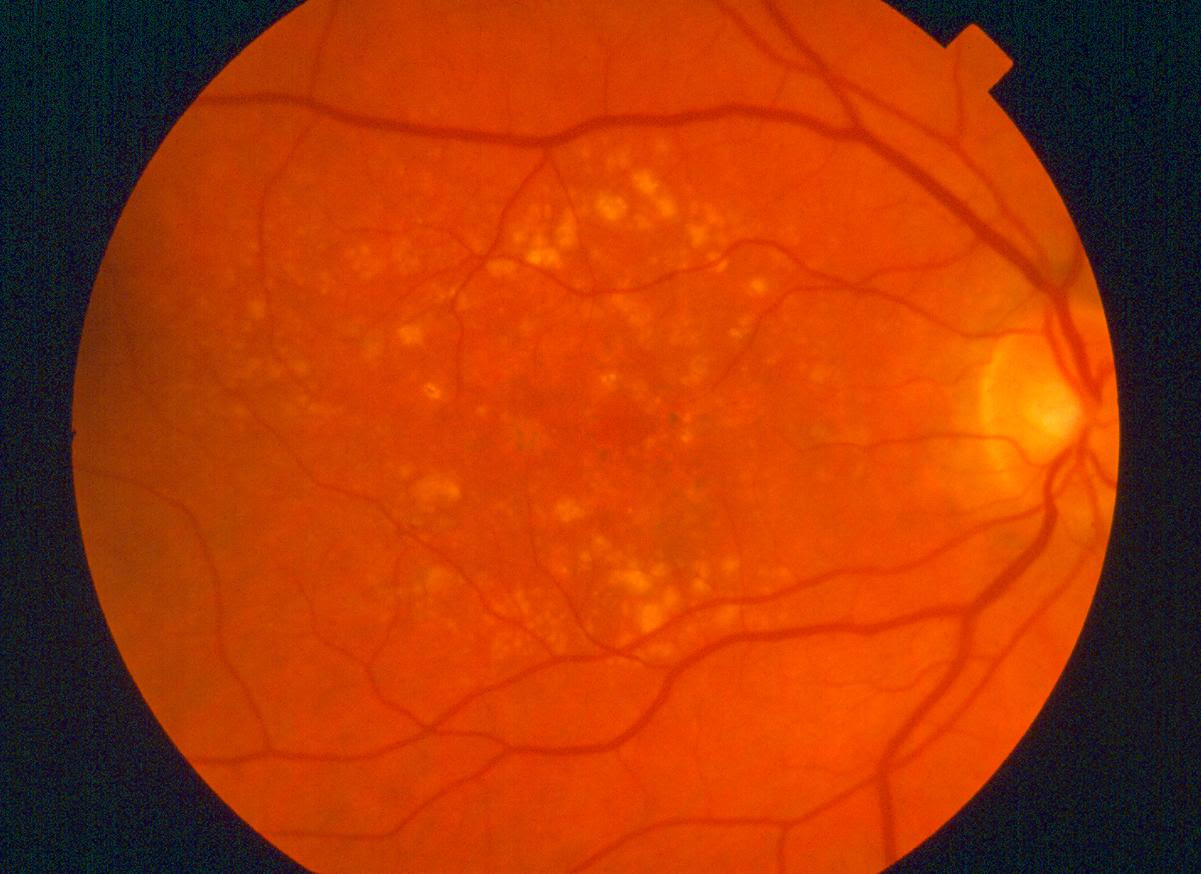 There are many risk factors for macular degeneration including: