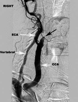 Carotid Artery Carotid Artery Occlusion Icd 10