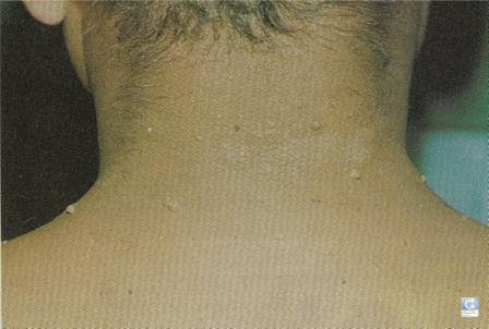 Global Dermatology Problemes De Peau Autour Des Yeux