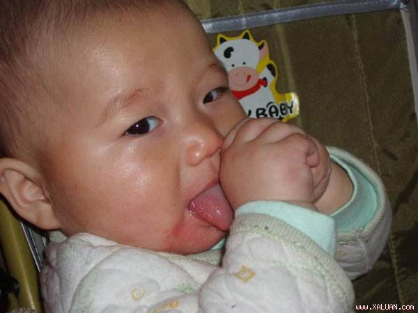 May mắn do bé được đưa đến bệnh viện kịp thời khi ngón tay chưa hoại tử.