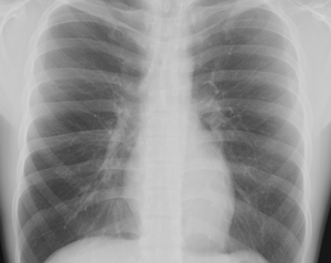 The Big difference Amongst Pleural Plaques and Pleural Thickening