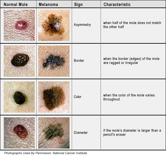 symbol itchy feet of Malignant melanoma? the are What symptoms of