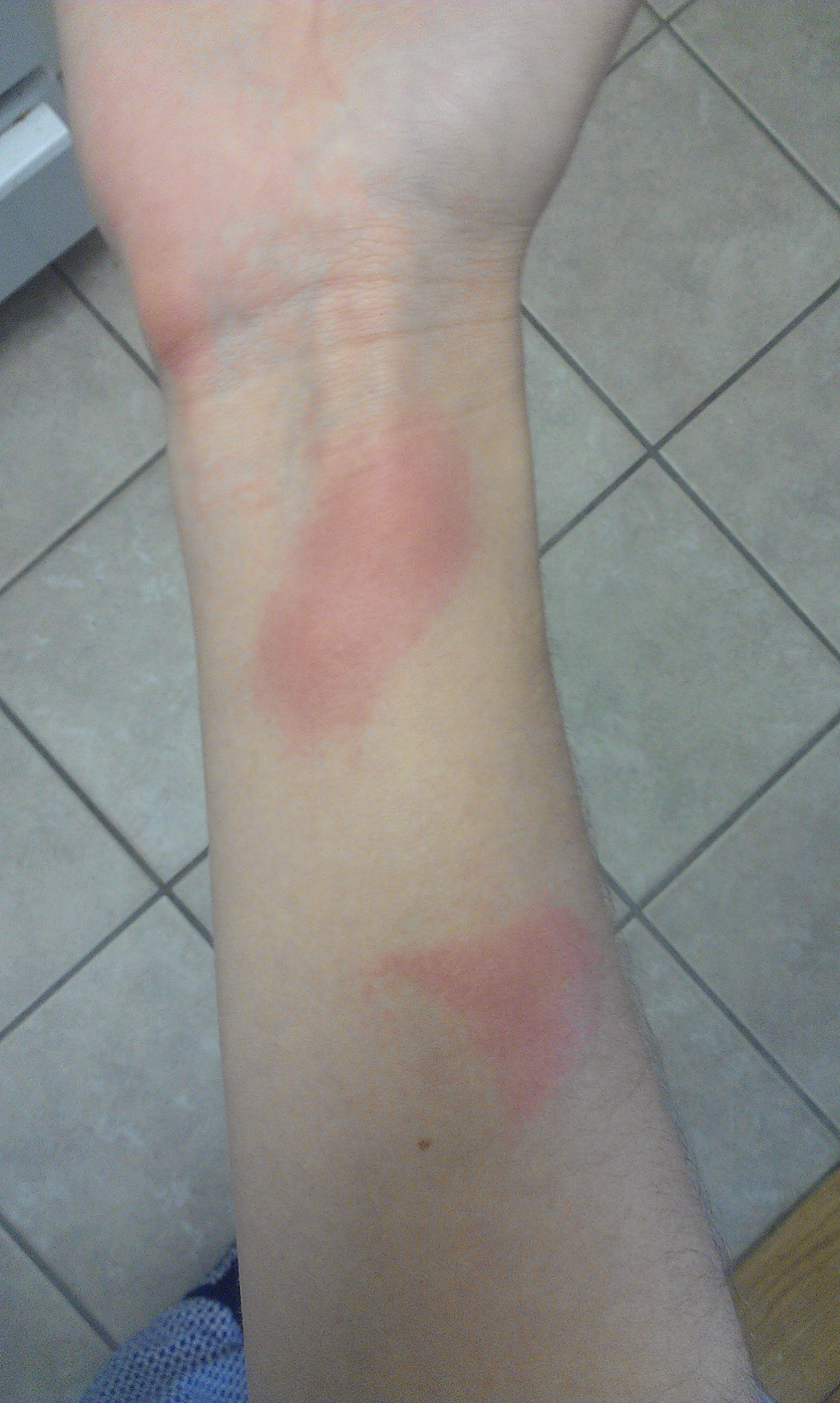 Bite ID Please (w/ pictures) Â« Got Bed Bugs? Bedbugger Forums