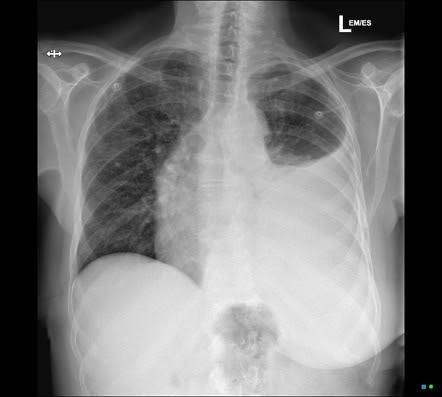 Mesothelioma Pleural Effusion Radiology - Mesothelioma Chest X Ray Wikidoc : These are the common radiological findings in mesothelioma ct scans: