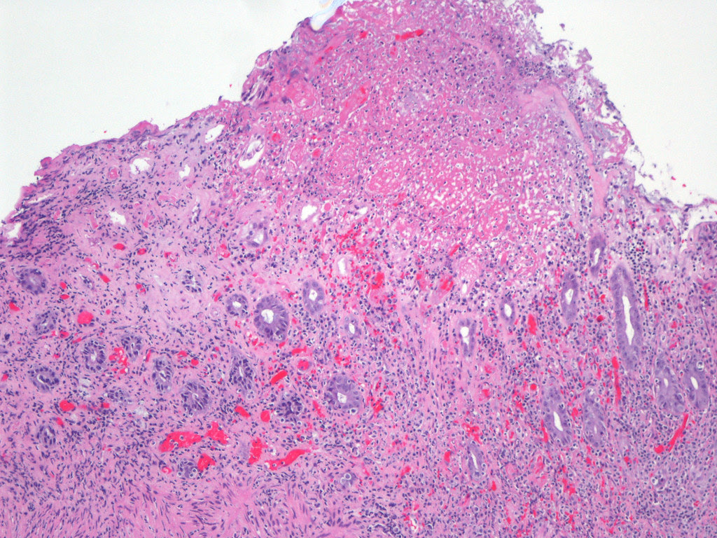 Yeast Infection Or Herpes - WISDOM TEETH REMOVAL INFECTION