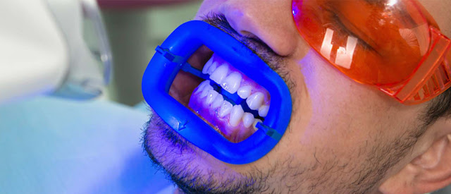 Teeth Whitening London | Private and NHS Treatments