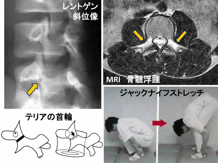 腰椎分離症