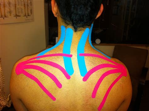 The best treatment for plantar fasciitis is wearing supportive shoes and stretching. DR Soroush Khoshroo Chiropractor Kinesio Taping