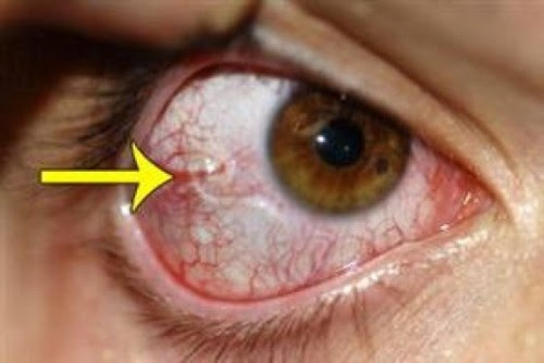 Party in My Eyes [Worms? Bacteria? Fungus?] at Parasites Support Forum 