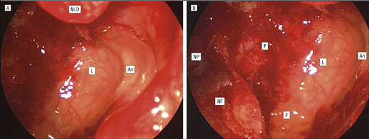 Sinusitis Wikipedia