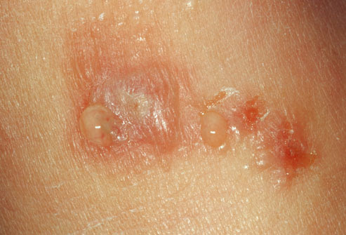 Common Childhood Skin Problems mild poison sumac rash. Common Childhood Skin Problems