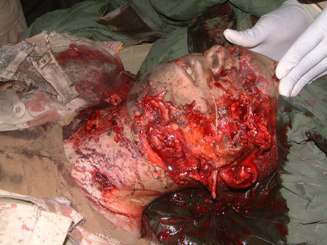 http://mindprod.com/image/restricted/iraqmissingeye.jpg