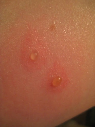 SYMPTOMS OF BED BUG BITES : SYMPTOMS OF BED - SIGNS AND  