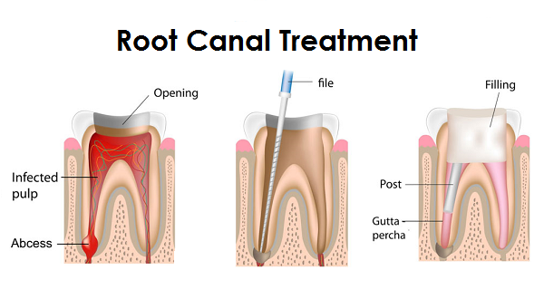 Root Canal Treatment Williams Ca Gill Dental