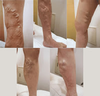 下肢静脈瘤とは ドクターが推薦する専門医療機関