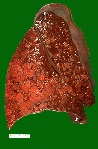 AIDS Pathology
