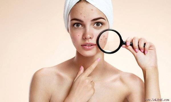 Mụn trứng cá hình thành xuất phát từ việc sản sinh quá nhiều chất nhờn từ các tuyến bã nhờn