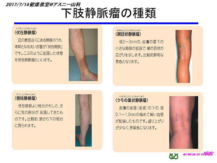 それって下肢静脈瘤 足がむくむ だるいがサイン 動画 らくわ健康教室 講演録