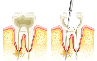 Root Canal Therapy For Kids