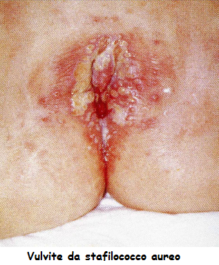 Stafilococco genitali femminili