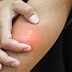 Spider Bites With Little Bumps - Staphylococcus aureas and group a streptococcus both cause skin infections that are regularly mistaken for spider bites.