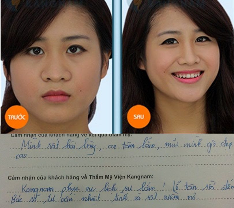 Kết quả cuộn cánh mũi như thế nào?