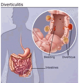How Serious is DIVERTICULITIS Disease?