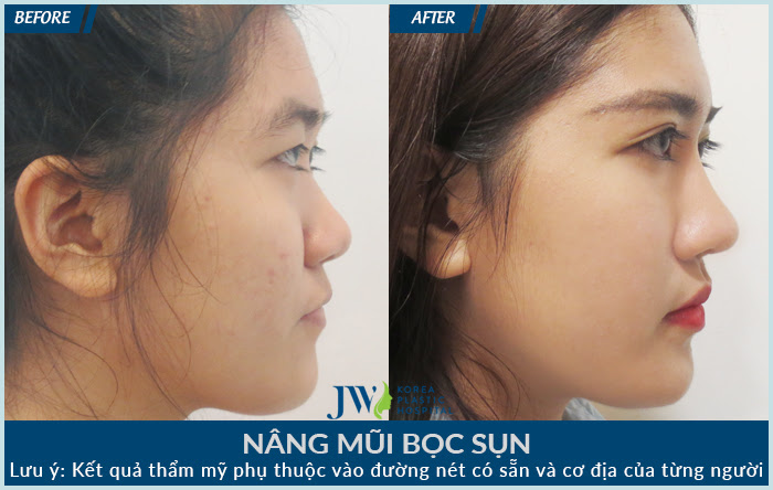 Phẫu thuật sửa mũi Hàn Quốc là gì?