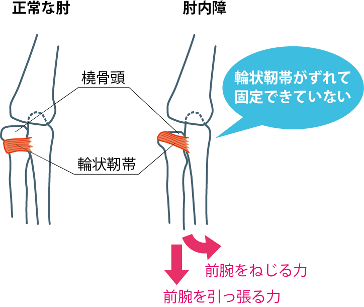 肘内障 肘の脱臼 岐阜市 本巣市 北方町のひまわり接骨院