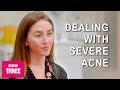 Adult Acne - Frustrating Problem With No Easy Answers