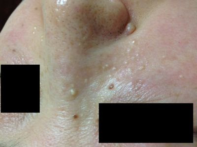 顔の白いぽつぽつ 稗粒腫 脂肪の塊 アーデ ベーグループ