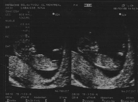 Les Echographies Connaissance Avec Bebe Neuf Mois A M Attendre Et Me Voila