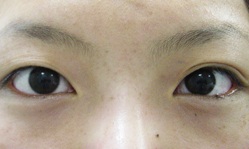 まぶたの悩み すがも小林皮フ科