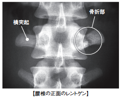 飯島整形外科 ドクター飯島のスポーツ医学ｑ A 腰椎横突起骨折