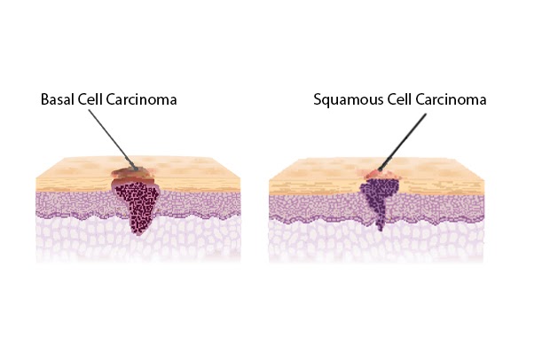 Skin Cancer Types Basal Cell Carcinoma : Types Of Skin Cancer Oncobeta / There are several different types of skin cancer with basal cell carcinoma, squamous cell carcinoma, bowen's disease, keratoacanthoma, actinic keratosis and melanoma most commonly occurring.