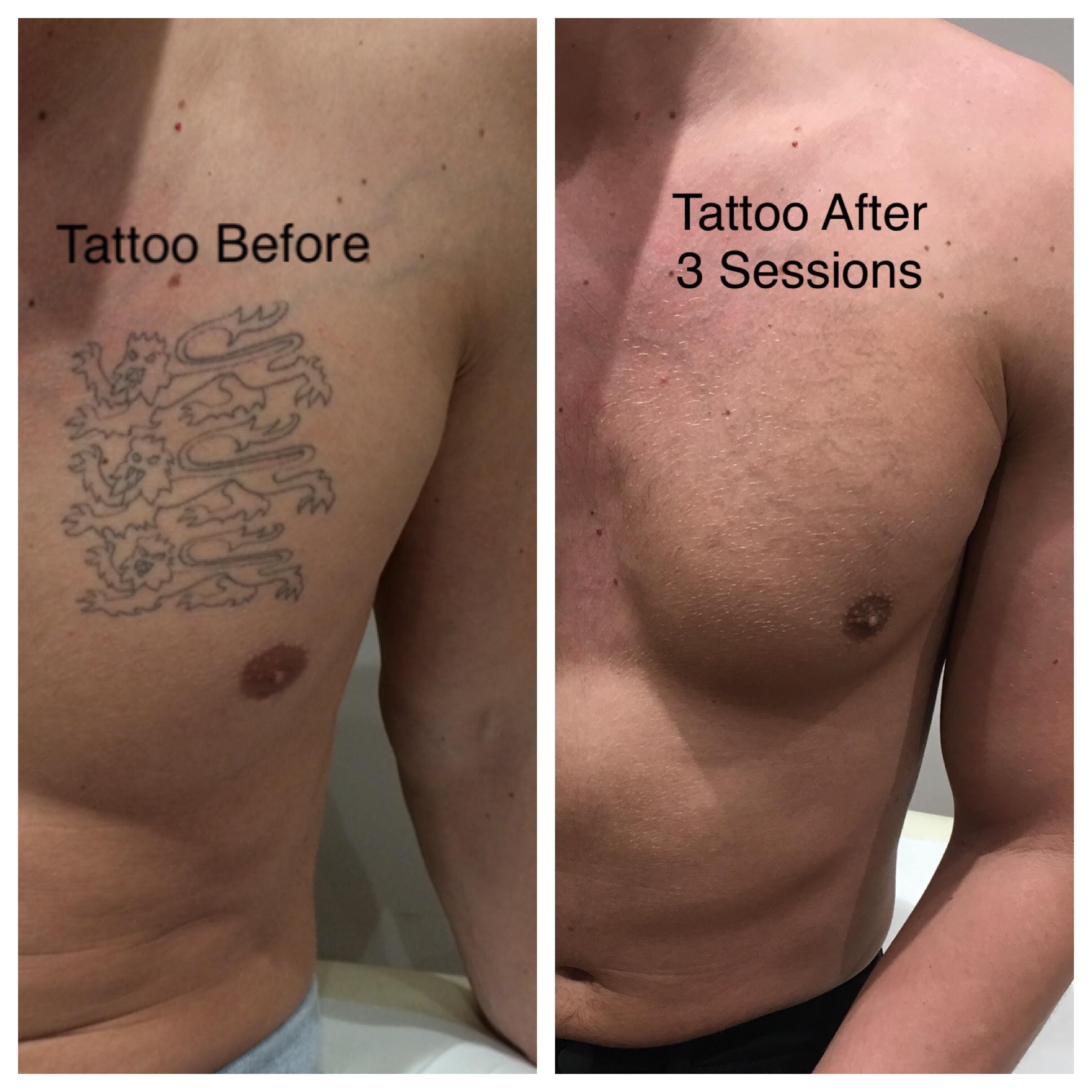 Tattoo Removal Treatment Laser