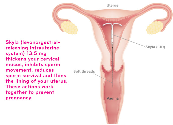 Iud Placement Paraguard Mirena Liletta Skyla K Anthony Shanbour M D Obstetrics And Gynecology Oklahoma City Ok