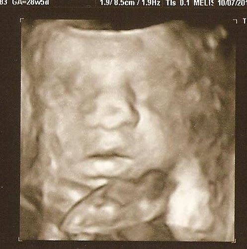 3D at 28 weeks 2