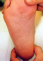 Don't delay your care at mayo clinic featured conditions plantar fasciitis is an inflammation of the fibrous tissue (plantar fascia) along the bottom of your foot that connects your heel bone to your toes. Plantar Fasciitis and Other Causes of Heel Pain - American