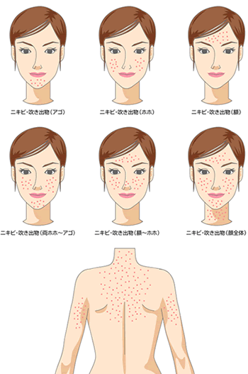 jerawat orang jepang