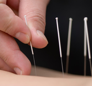 Acupuncture also helps