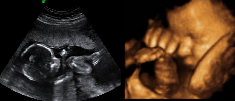 Best Time For 3d 4d Ultrasound Baby Gender Boardman Ohio