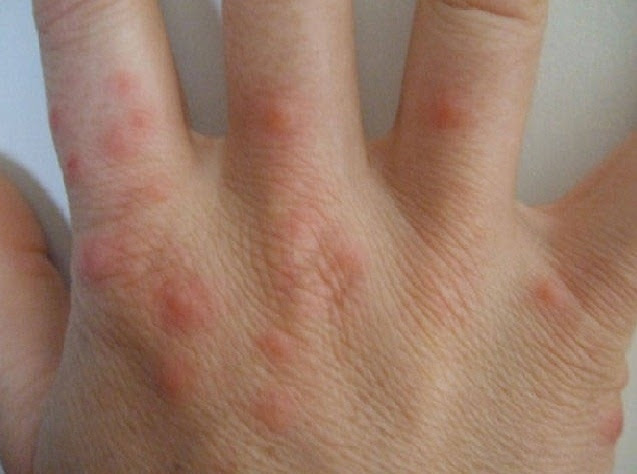 Bed Bugs Toronto - Affordable Bed Bugs Exterminator Toronto - Pestend