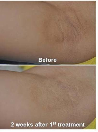 Dark Armpit Groin Yoskarn Clinic Plastic Surgery Thailand Cosmetic Surgery Thailand Breast Augmentation Thailand Nose Surgery Thailand Hormone Therapy Thailand Facelift Thailand