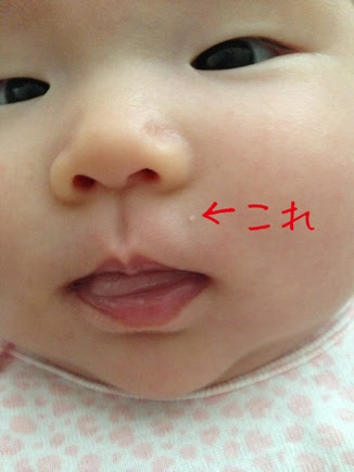 赤ちゃんに良くあるらしいデキモノ ビッグ アイランド日和