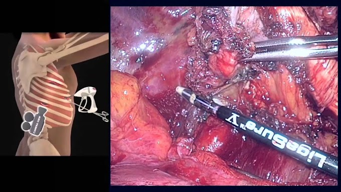 Malignant Pleural Mesothelioma Uk - Apical Pleural Thickening Fibrosis - Where a chest radiograph is suggestive of malignant pleural disease, a copy report should ideally be sent to a designated member of the lung cancer .