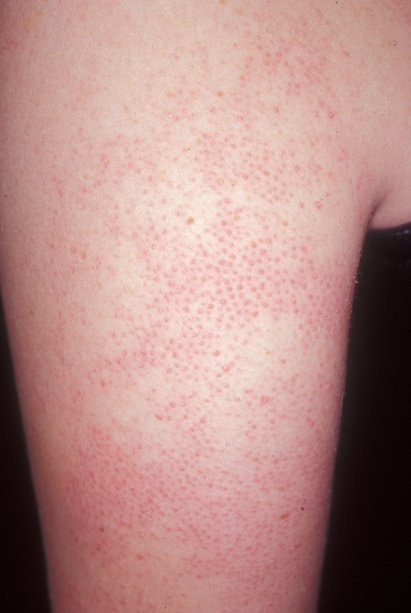 Keratosis Pilaris On Arms