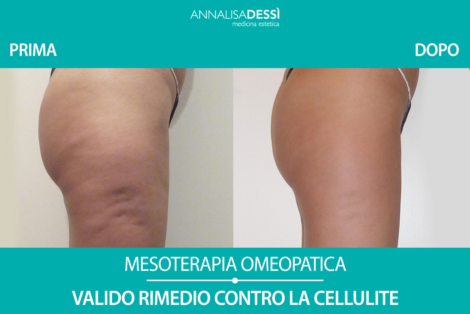 rimedi per la cellulite