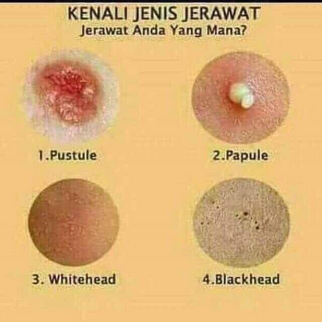 MyMurah.com - Acne Care - Cara Mudah Menghilang Jerawat 